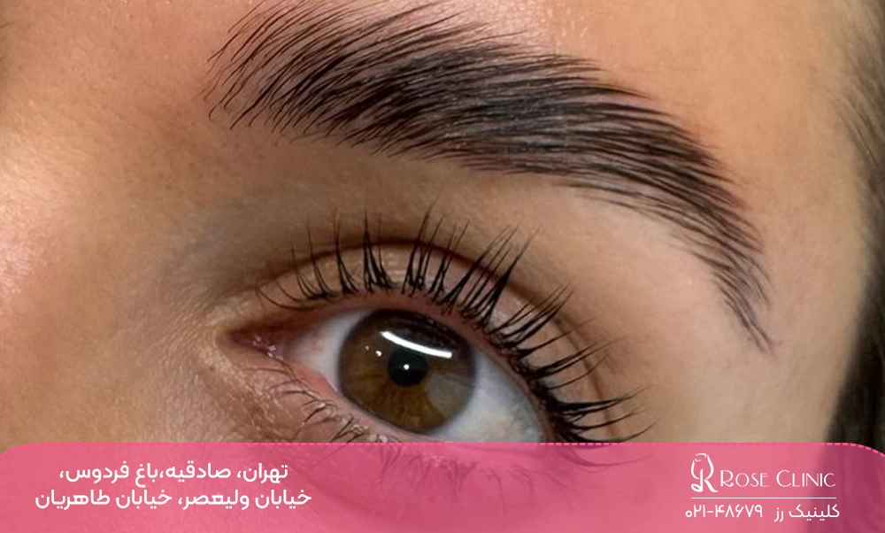 لیفت ابروی کاشته شده