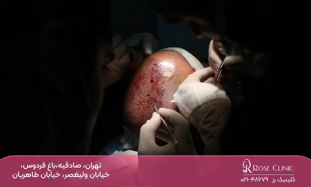 ممنوعیات بعد از کاشت مو