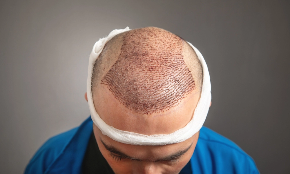 کاشت مو به روش Super FUE