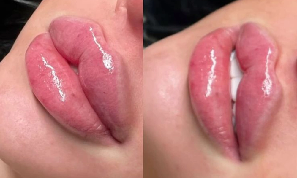 شکل ژل لب روسی بعد از تزریق ژل