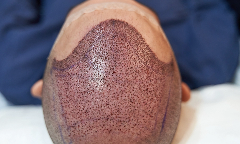 کاشت مو موفق بعد از عمل کاشت