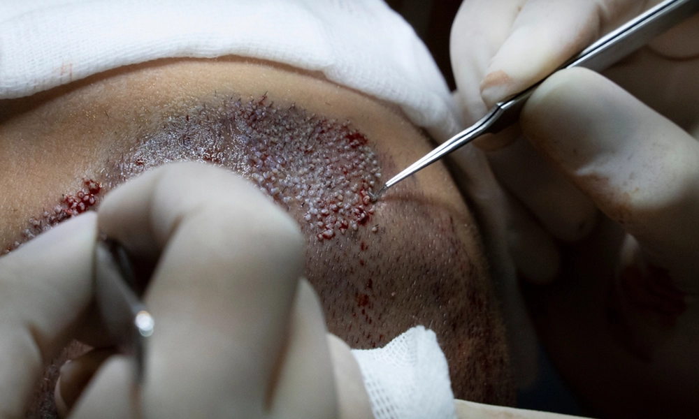 عکس کاشت مو به روش Super FUE