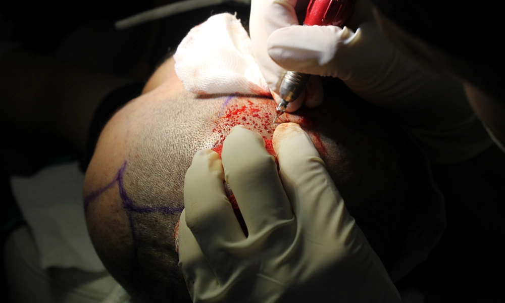 کاشت مو به روش fue توسط پزشک برای متقاضی