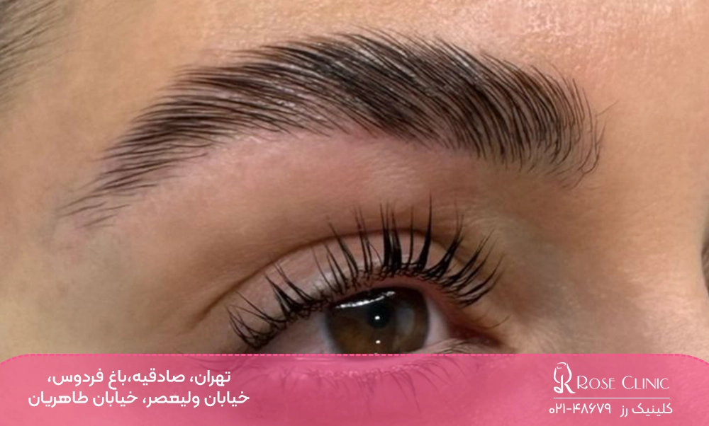 لیفت ابروی کاشته شده