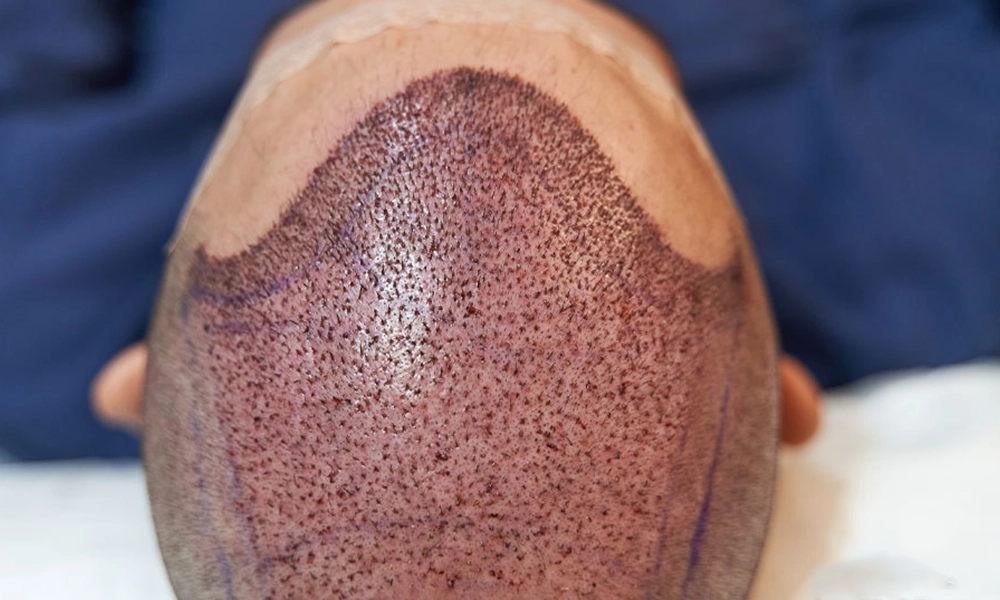 مدل پوسته شدن سر بعد از کاشت مو