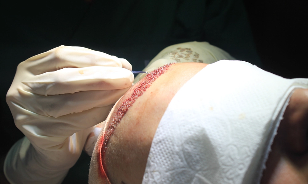 پزشک در حال کاشت مو به روش fue