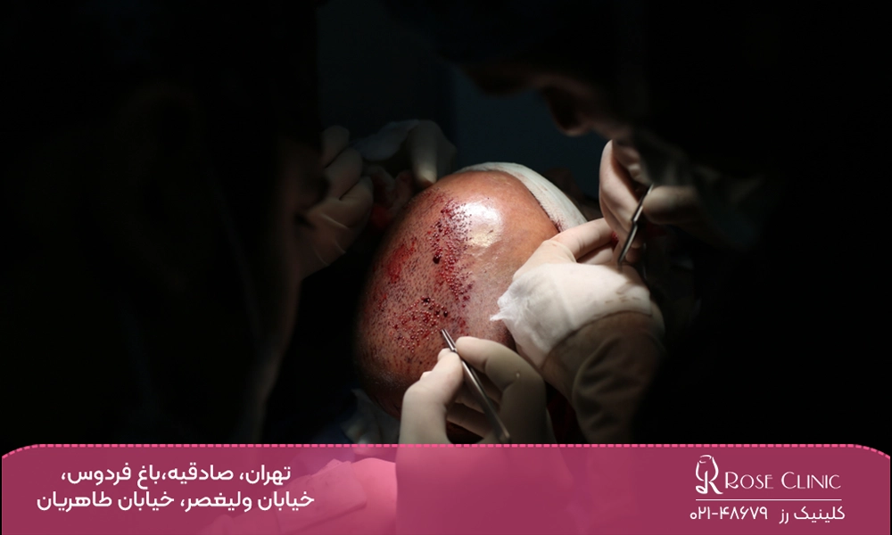 اواخر عمل کاشت مو به روش نیوگرافت