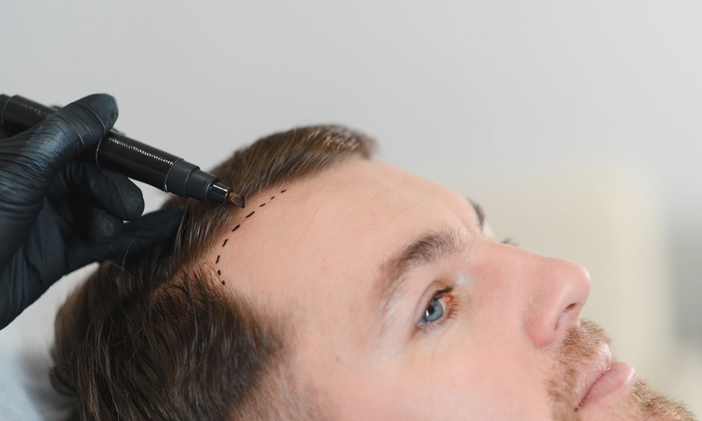 معاینه اولیه برای کاشت مو بدون تراشیدن سر