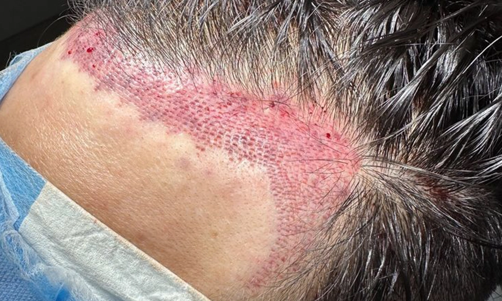 عکس کاشت مو شقیقه دقیقا بعد از کاشت