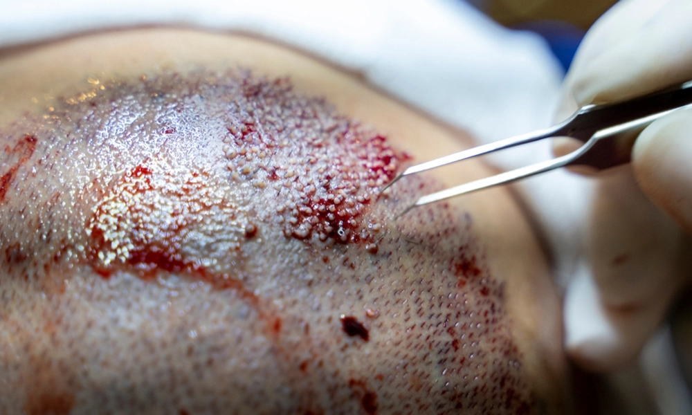 نحوه کاشت مو به روش Super FUE