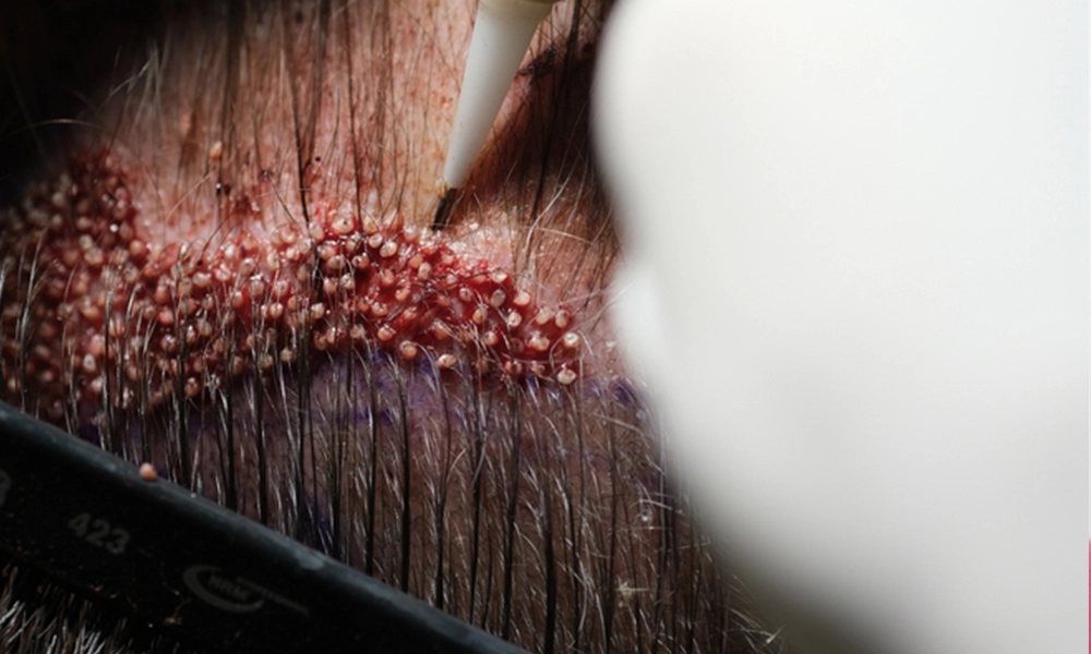 پزشک در حال کاشت مو بدون تراشیدن سر