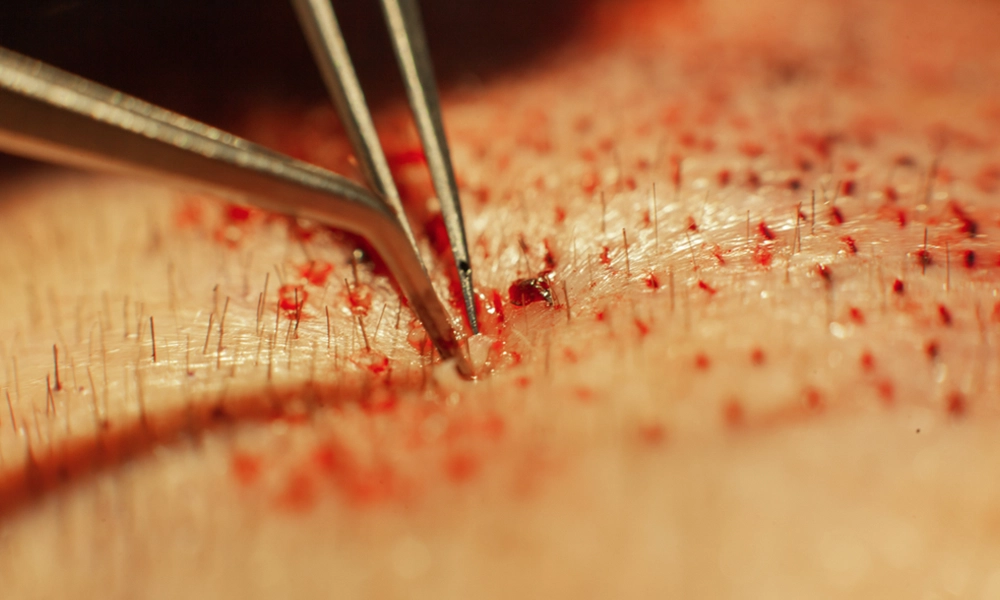 پزشک در حال کاشت مو با الیاف نانو