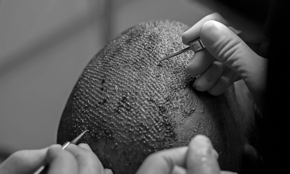 پزشک در حال کاشت موهای سر متقاضی | خارش سر بعد از کاشت مو