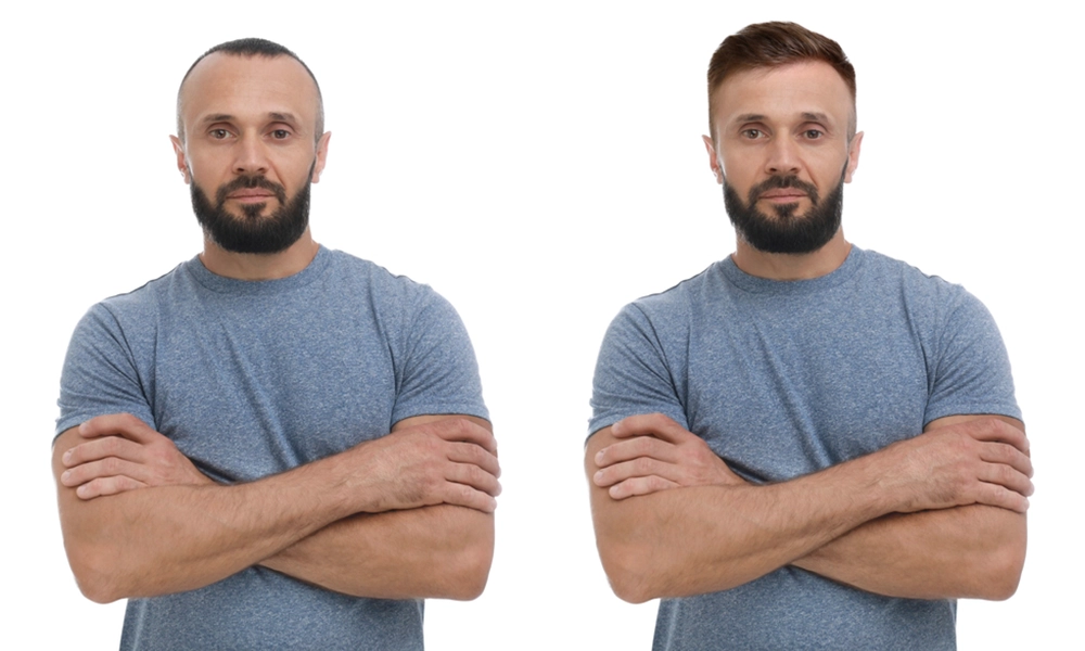 عکس قبل و بعد کاشت مو موفق