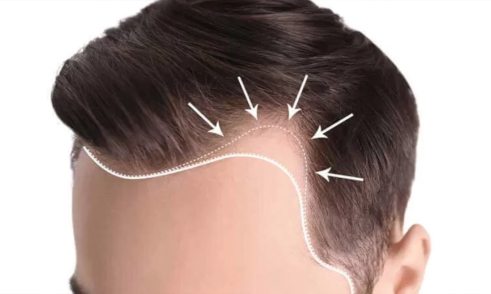 عکس خالی بودن شقیقه و اقدام برای کاشت مو شقیقه