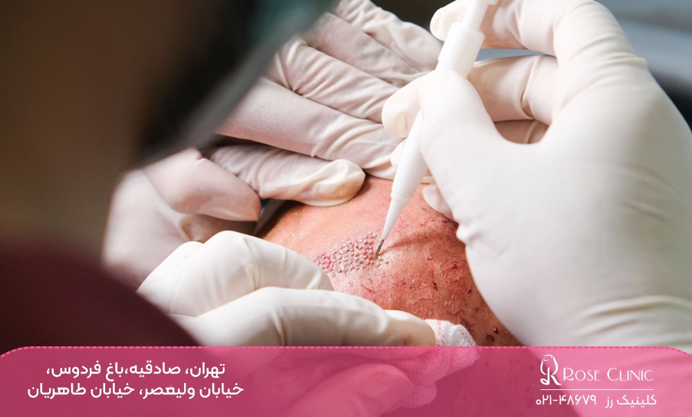 DHI بهترین روش کاشت مو در دنیا