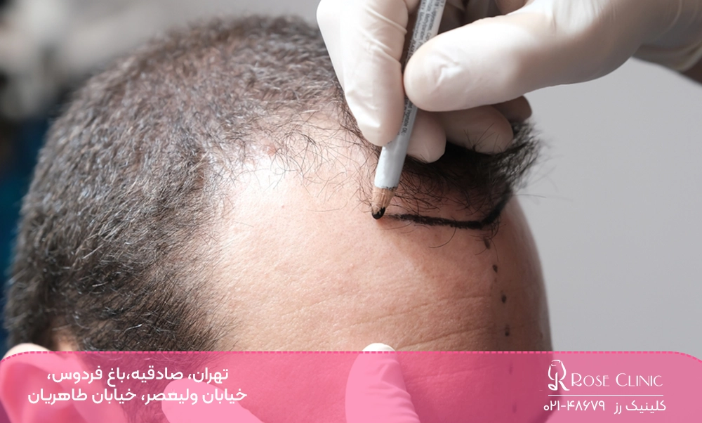 بهترین روش کاشت مو در دنیا برای آقایان