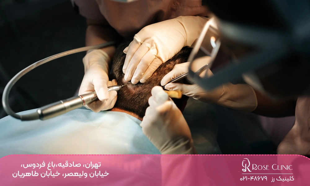 انجام بهترین روش کاشت مو در دنیا