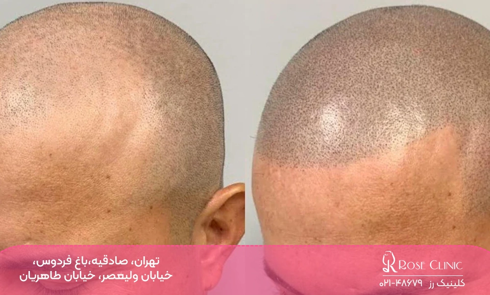 قبل و قبل تتوی سر