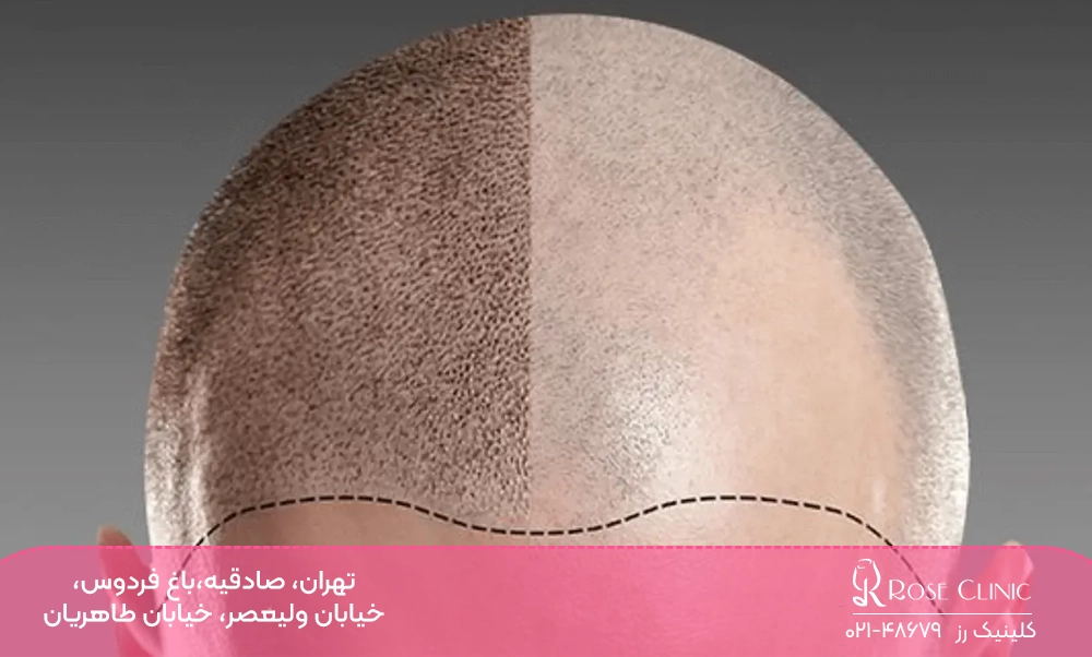 قبل و بعد تتوی سر