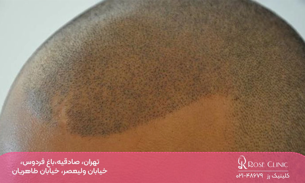 تتوی سر یا اسکالپ