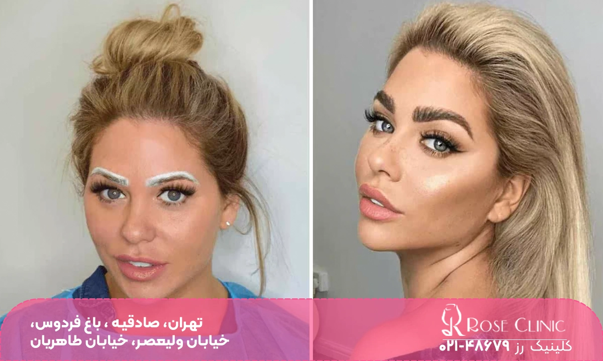 قبل و بعد کاشت ابرو | فیبروز ابرو بعد از کاشت