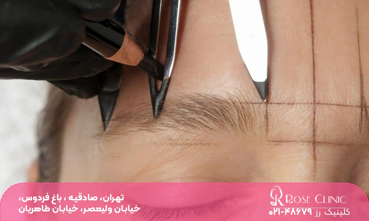 مشخص کردن نقاط برای کاشت ابرو | فیبروز ابرو بعد از کاشت
