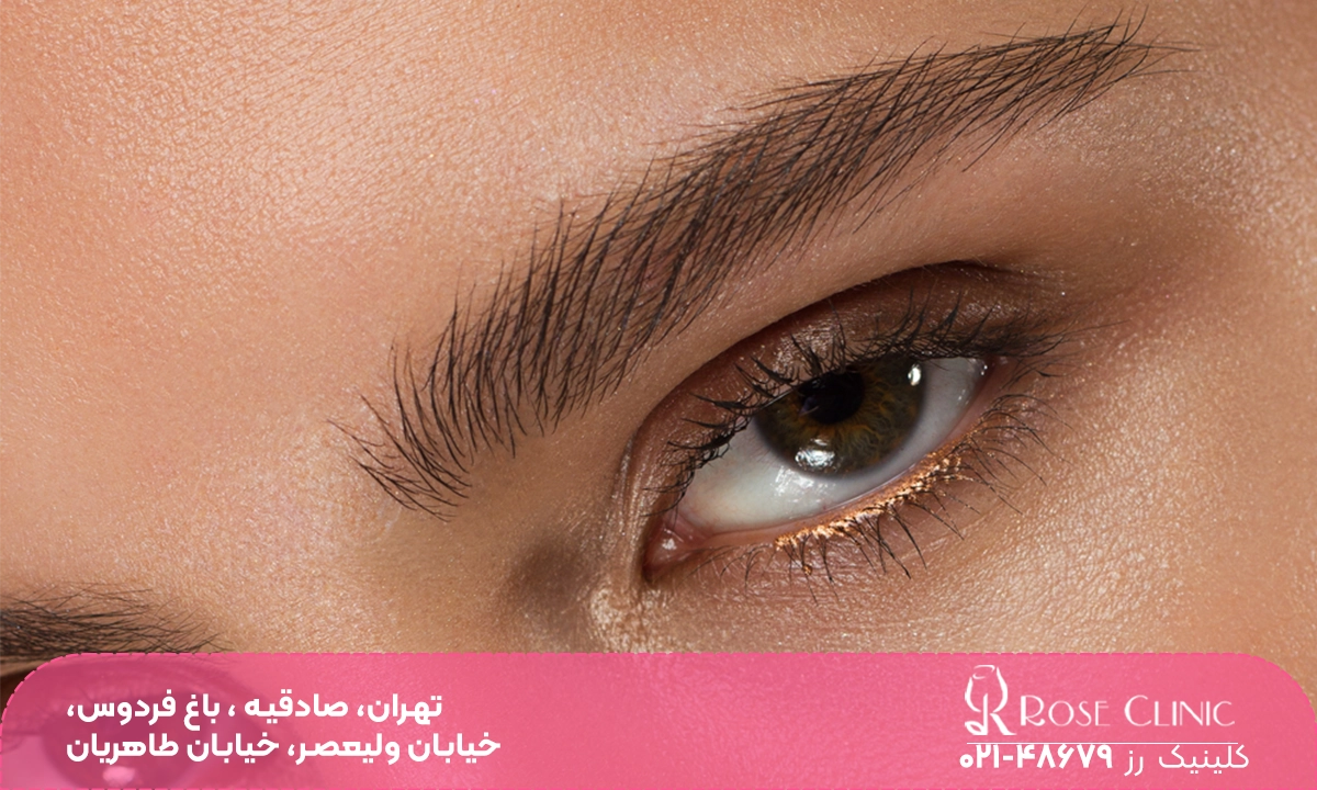 تصویر هاشور ابرو بعد از کاشت