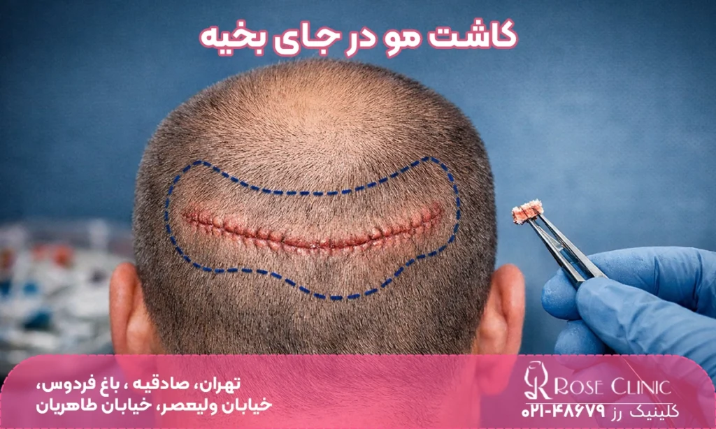 پوشاندن بخیه با کاشت مو | کاشت مو در جای بخیه