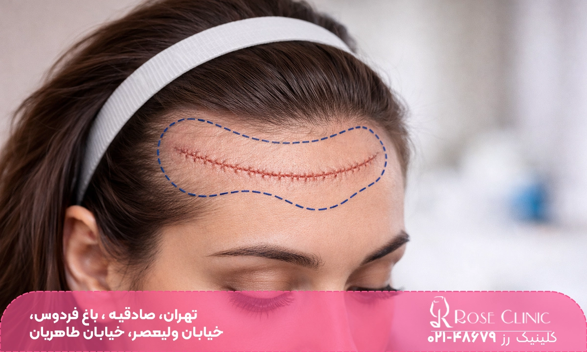 جای بخیه جلوی موی یک خانم | کاشت مو در جای بخیه