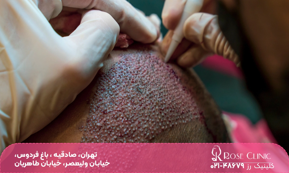 کاشت مو به روش Super FUE Plus