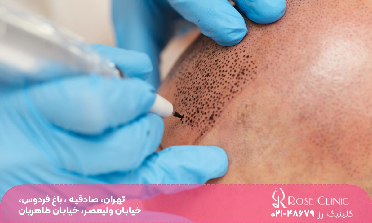 کاشت مو به روش Super FUE Plus