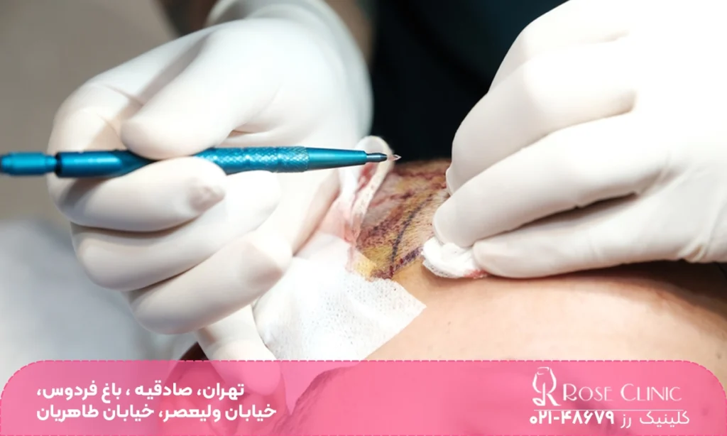 کاشت مو به روش Super FUE Plus