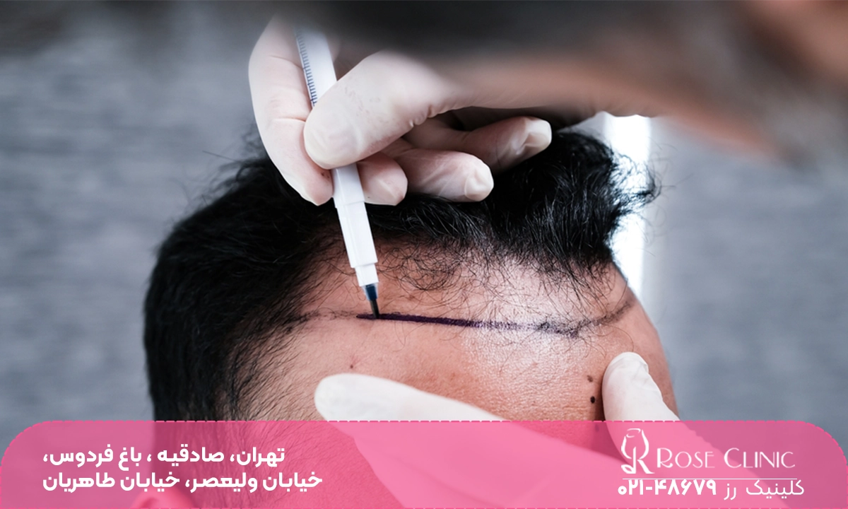 کاشت مو یک روزه