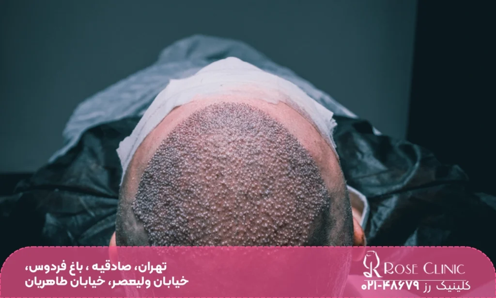 کاشت مو یک روزه