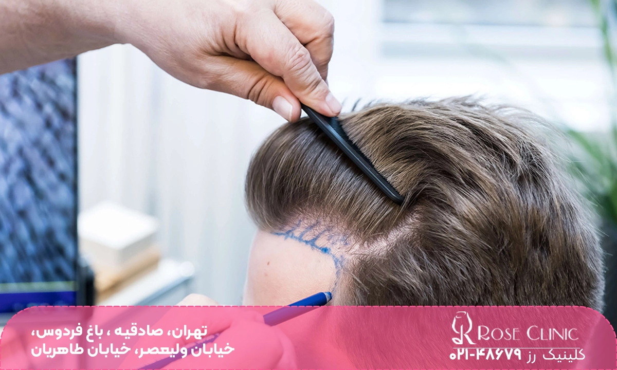 کاشت مو و اطلاعات تکمیلی رابطه زناشویی بعد از عمل